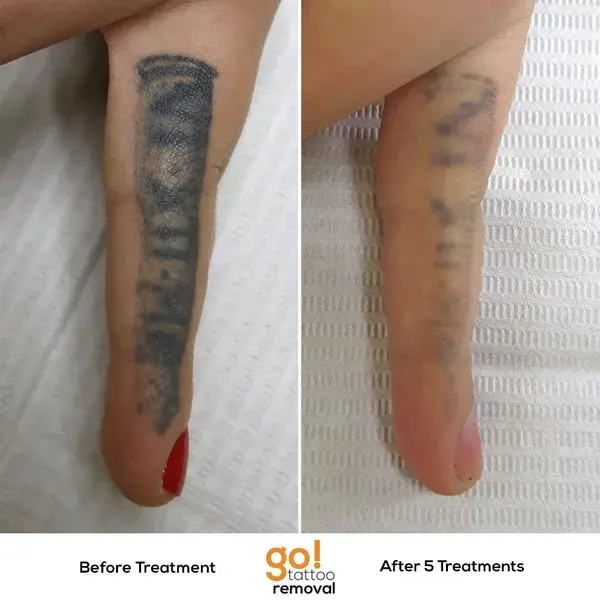 www.gotattooremoval.com