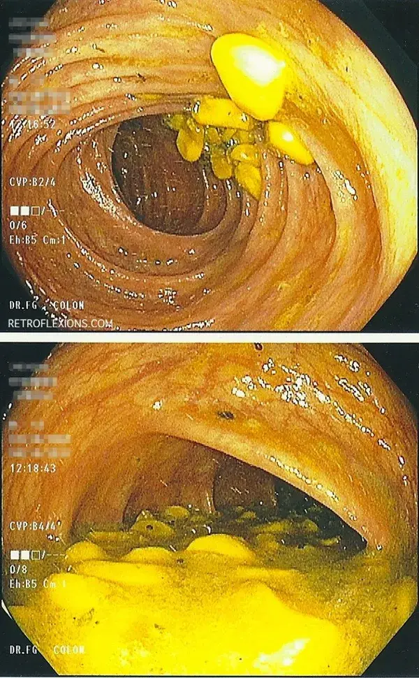 Retroflexions.com &raquo; A gastroenterologist cheats on the colonoscopy prep and wins!