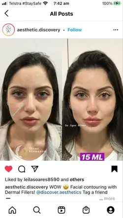 Before and after face filler