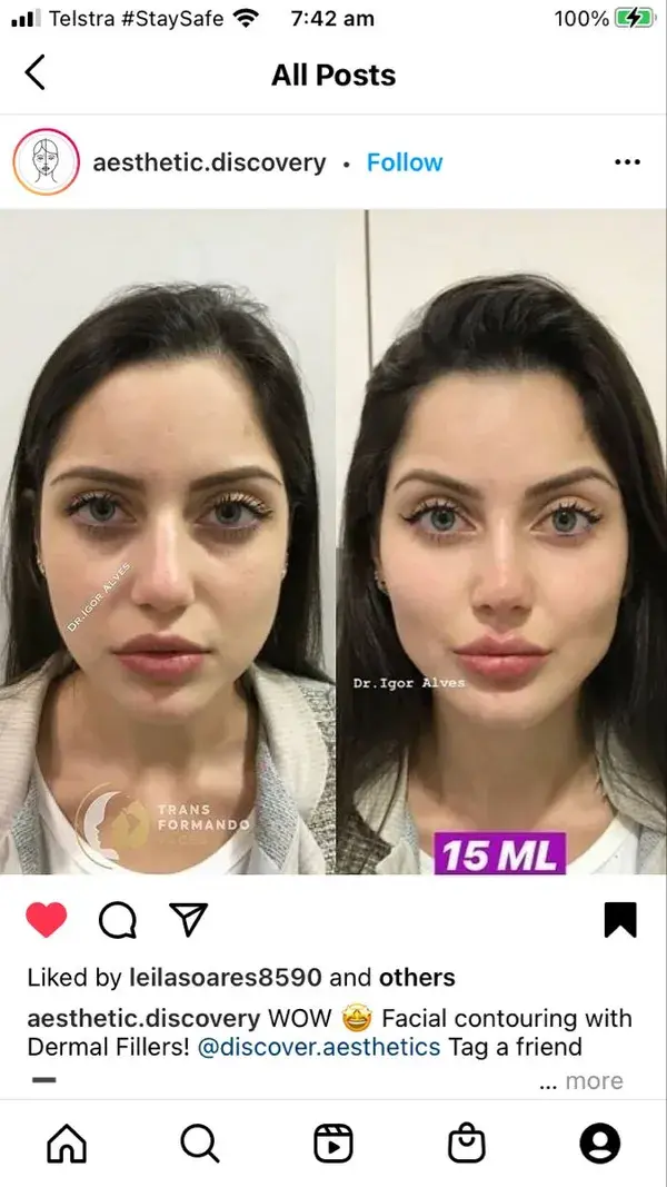 Before and after face filler