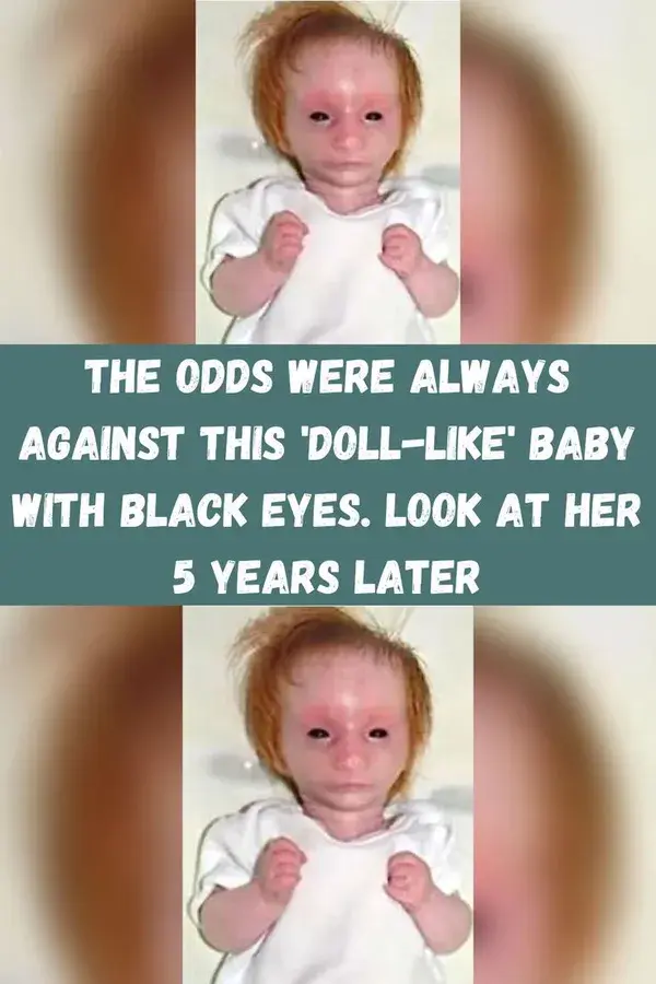The Odds Were Always Against This 'Doll-Like' Baby With Black Eyes. Look At Her 5 Years Later
