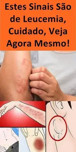 Estes Sinais São de Leucemia Cuidado, Veja Agora Mesmo!