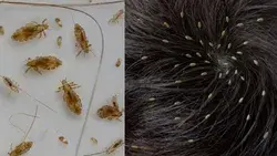 एक बार में सिर की सारी जुएँ भगाएं Lice Removal at home, Get Rid of Head Lice / How to Remove Lice? -