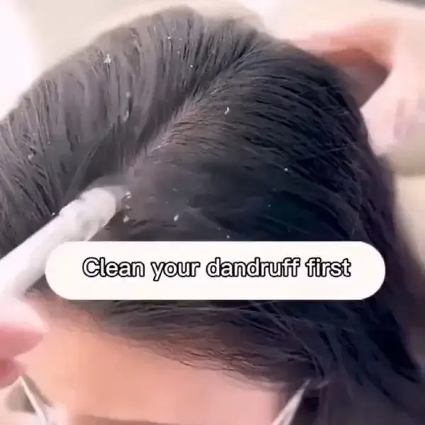Hair brush, Dandruff remedy