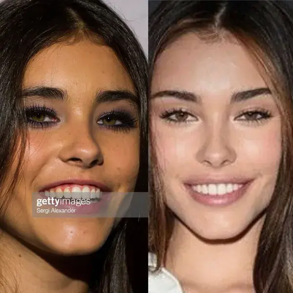 Madison Beer plastic surgery