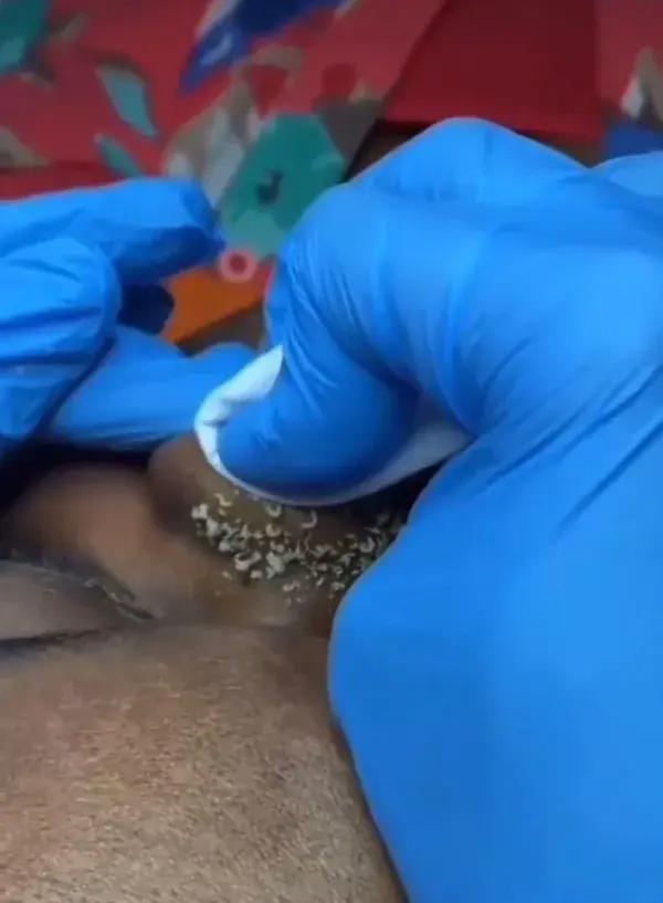 Blackheads satisfying videos