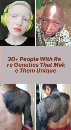 30+ People With Rare Genetics That Make Them Unique