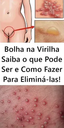 Bolha na Virilha - Saiba o que Pode Ser e Como Fazer Para Eliminá-las!