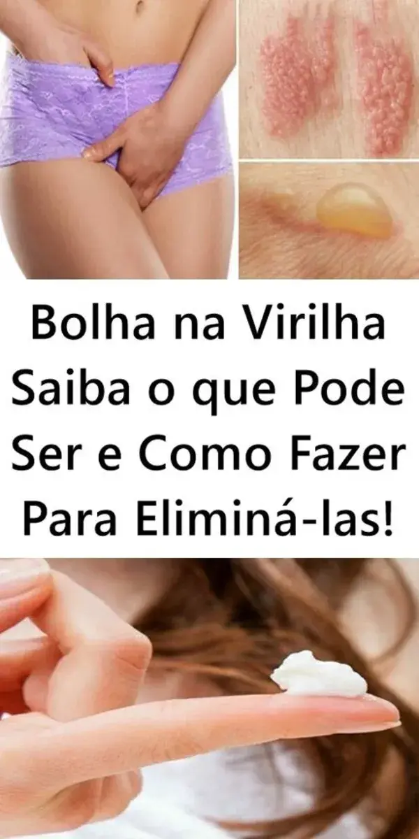 Bolha na Virilha Saiba o que Pode Ser e Como Fazer Para Eliminá-las!