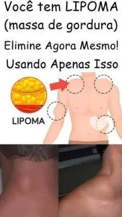 Tratamento Caseiro Para Eliminar Lipoma de Forma Natural!