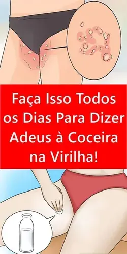 Faça Isso Todos os Dias Para Dizer Adeus à Coceira na Virilha!