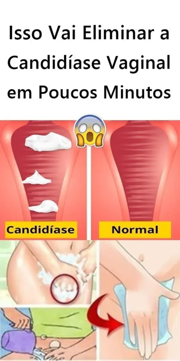 Isso Vai Eliminar a Candidíase Vaginal em Poucos Minutos