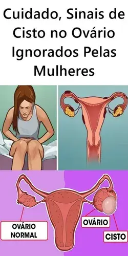 Sinais de Cisto no Ovário Ignorados Pelas Mulheres