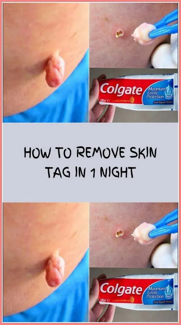 How to Remove Skin Tag in 1 Night