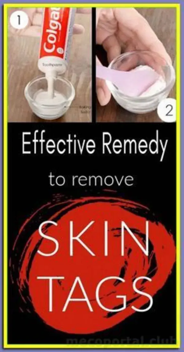 HOW TO REMOVE SKIN TAG IN 1 NIGHT