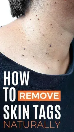 12 Incredible Home Remedies To Remove Skin Tags