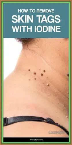 How to Remove Skin Tag in 1 Night