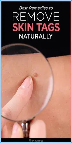 How to Remove Skin Tag in 1 Night