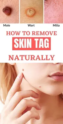 HOW TO REMOVE SKING TAG NATURALLY