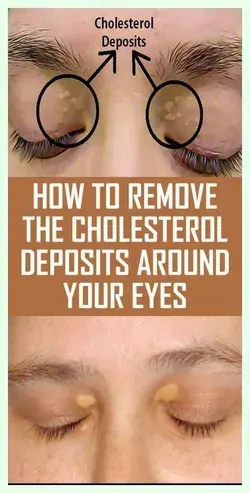 How to Remove the Cholesterol Deposits Around Your Eyes