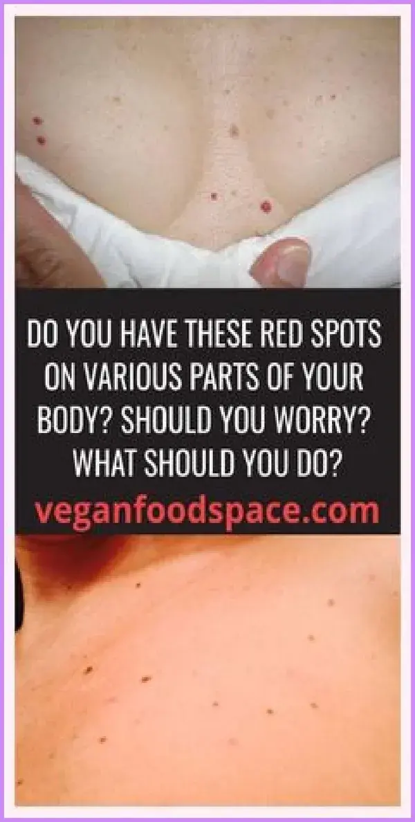 Do You Have These Red Spots On Various Parts Of Your Body