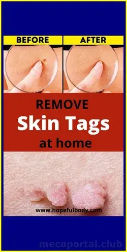 HOW TO REMOVE SKIN TAG IN 1 NIGHT