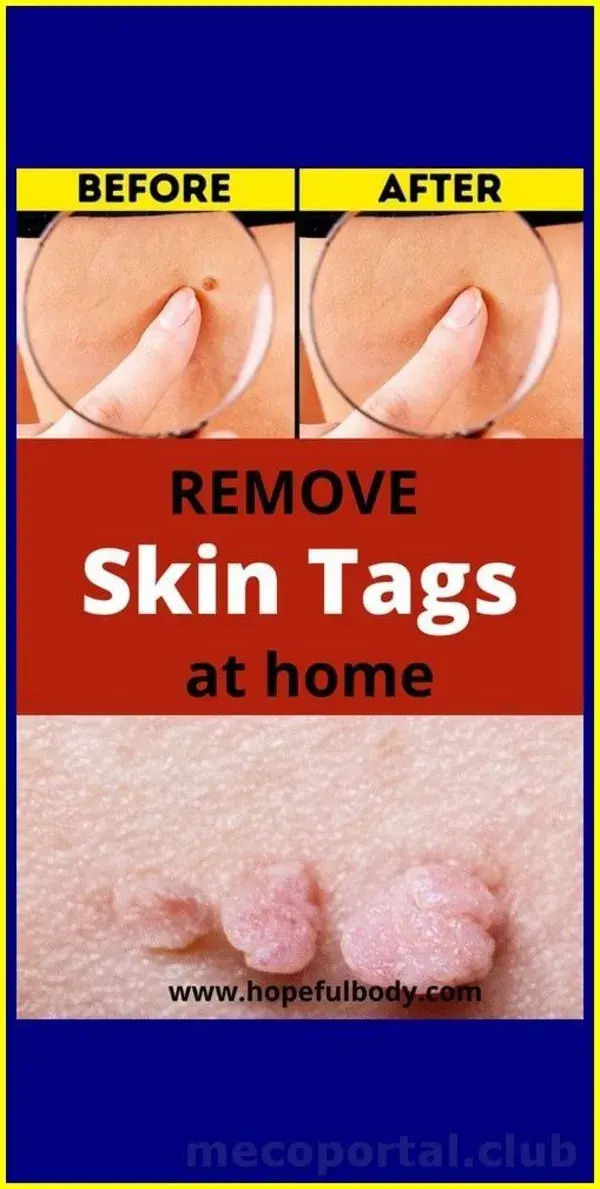 HOW TO REMOVE SKIN TAG IN 1 NIGHT