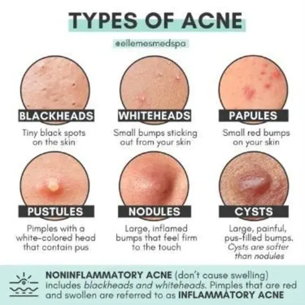 Types of Acne