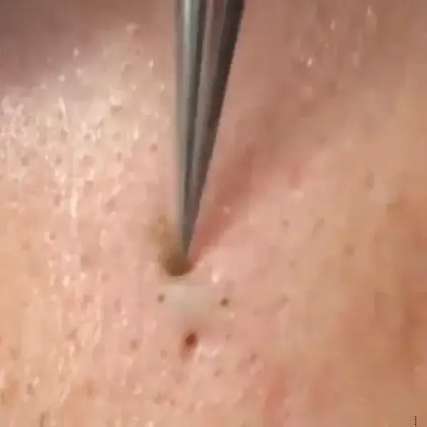 Blackheads removal