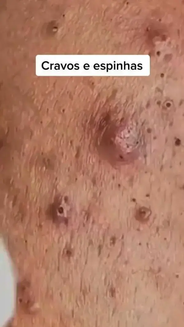 Blackhead removal