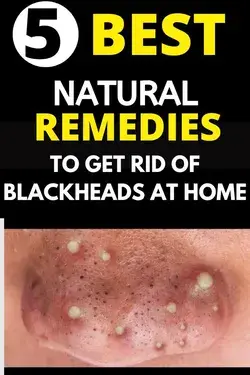 Overnight Trick To Get Rid of Blackheads Instantly and easily at home