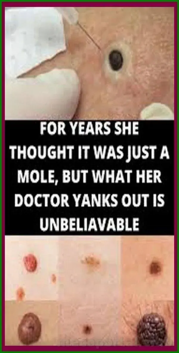 FOR YEARS SHE THOUGHT IT WAS JUST A MOLE, BUT WHAT HER DOCTOR YANKS OUT IS UNBELIAVABLE