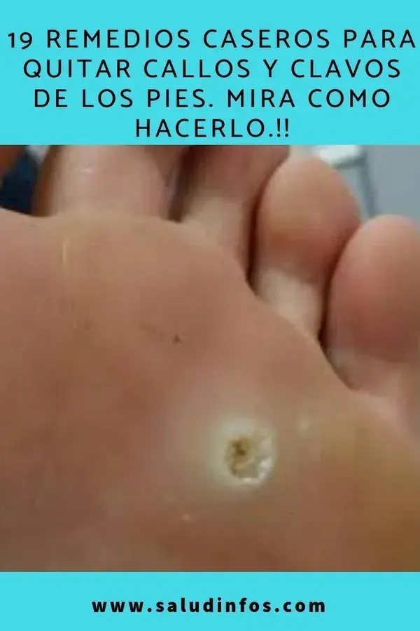 ¿Cómo curar los hongos delas uñas con vinagre y bicarbonato?