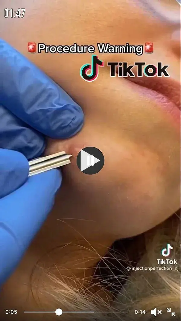 Blackheads extraction sati..!!