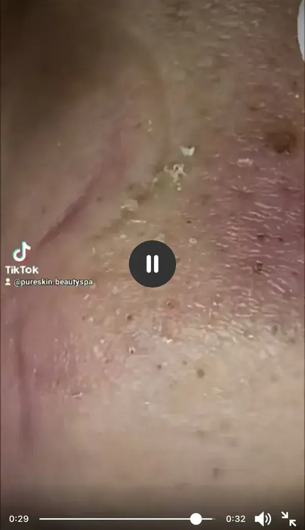 blackheads satisfying removal video