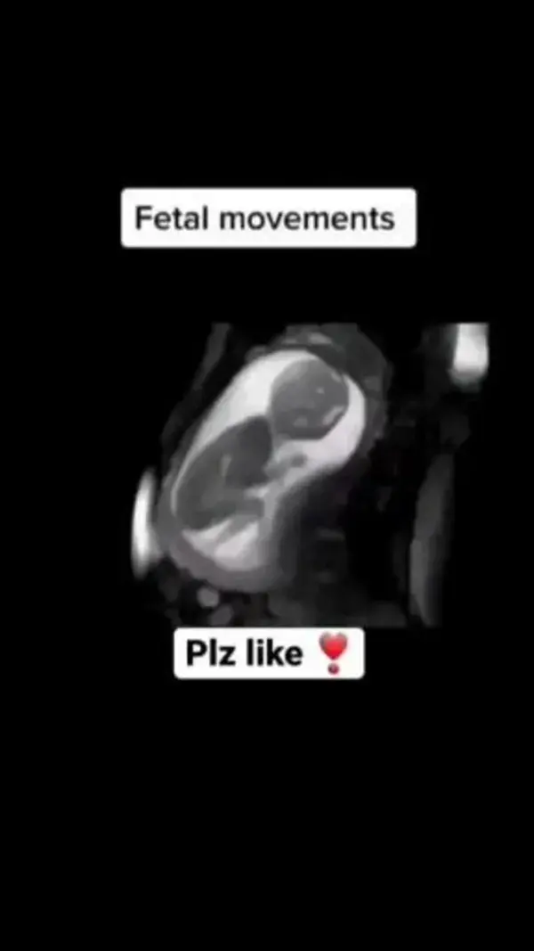 Baby in fetal movement