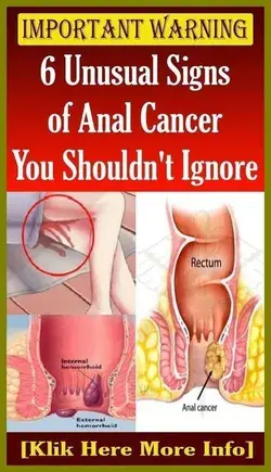 6 Unusual Signs of Anal Cancer You Shouldn�t Ignore