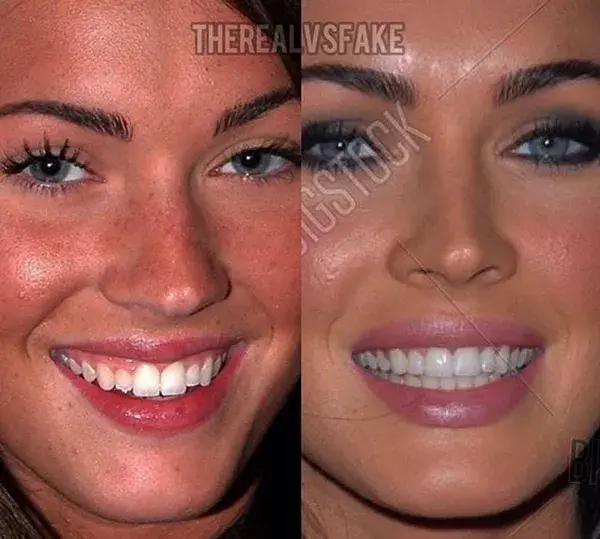 Megan Fox: Before & After Surgery on her Teeth & Lips