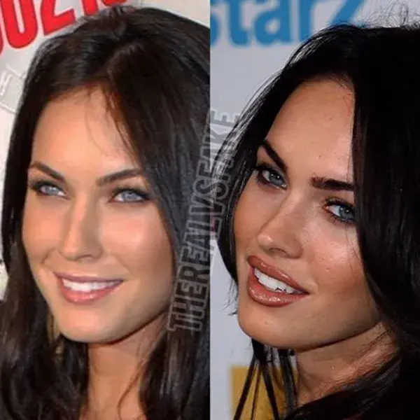 Megan Fox: Before & After Surgery