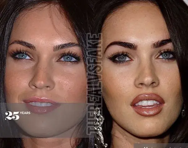 Megan Fox: Before & After Surgery