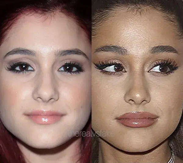 Ariana Grande: Nose Job/Lip Fillers/Spray Tan Before & After