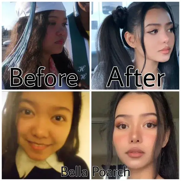 Bella Poarch nosejob and eyelid surgery