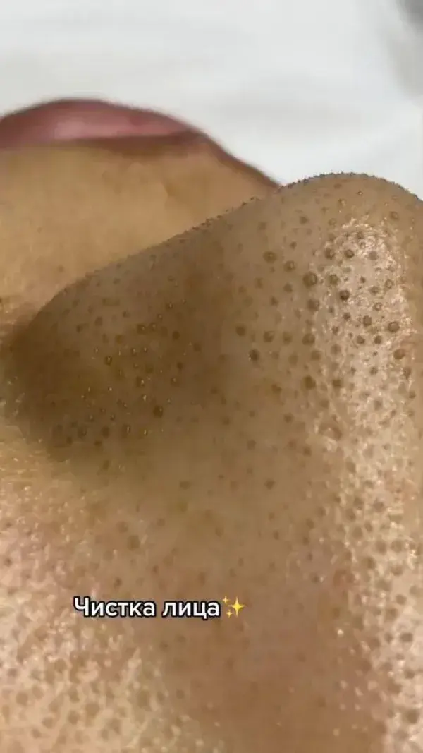 Blackheads Satisfying Removal