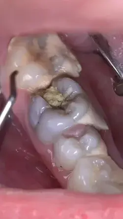 Cleaning Cavity 🦷