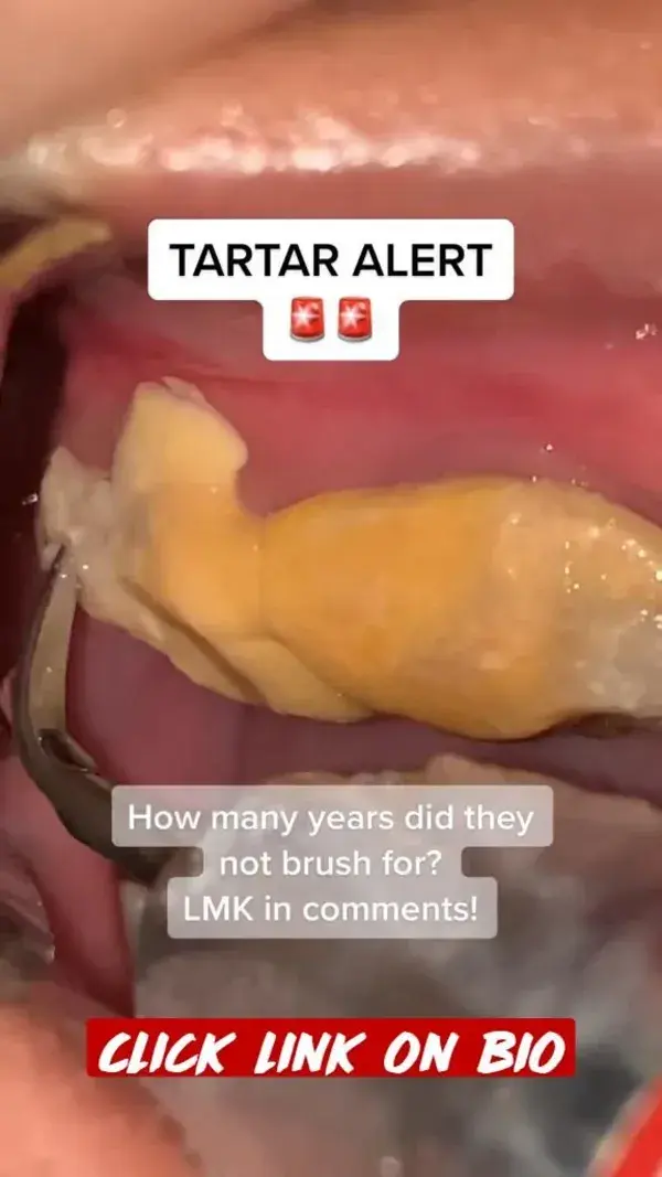 Tartar Alert