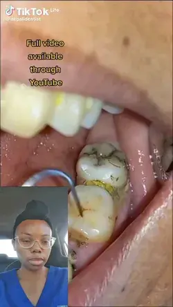 What happens when you don't brush properly - dentist explains