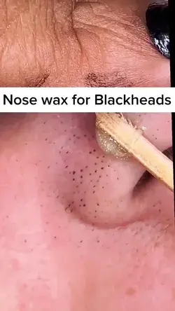 #NOSE WAX FOR BLACKHEADS