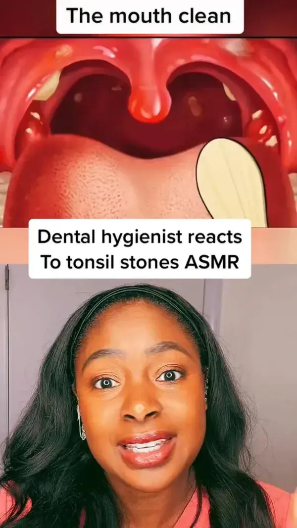 Dental hygienist reacts to tonsil stones ASMR