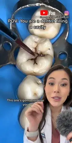 You’ll never believe how many tonsil stones come out!