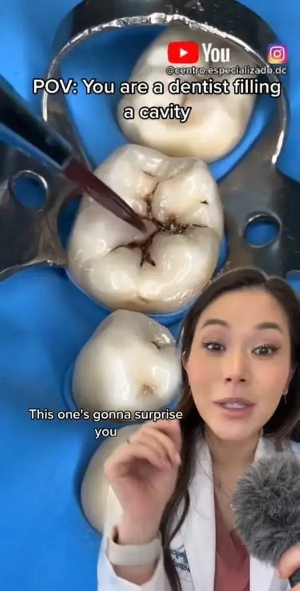 You’ll never believe how many tonsil stones come out!